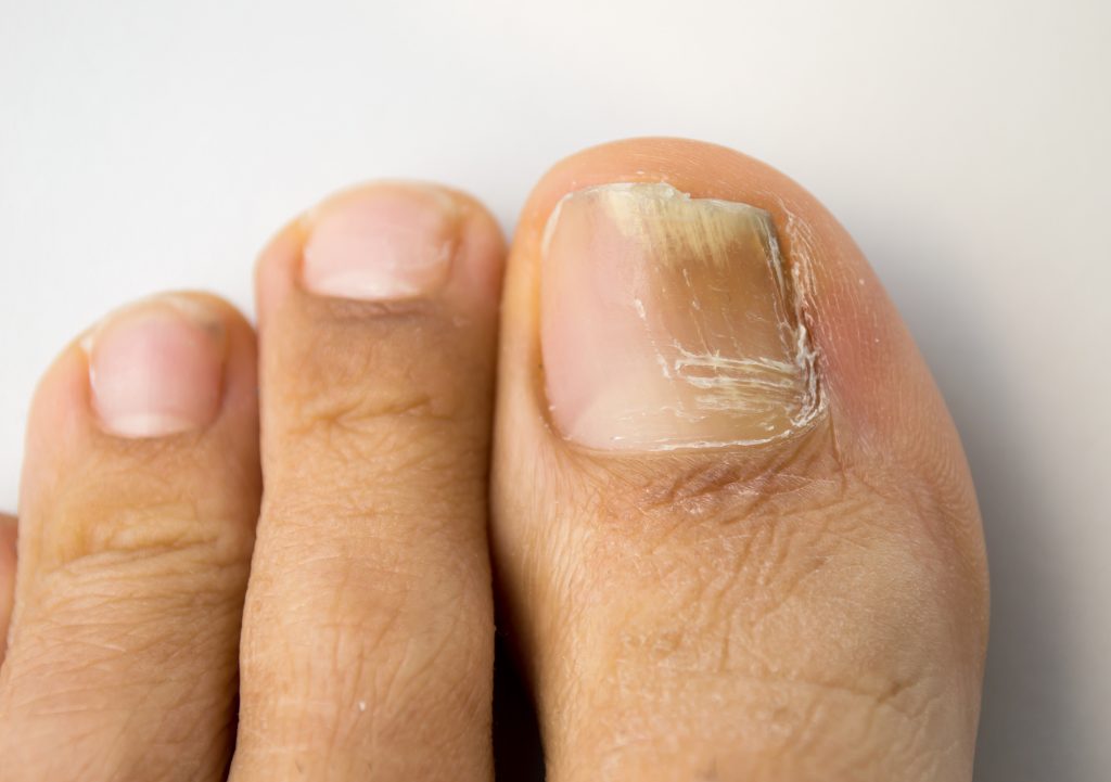 Does Garlic Cure Foot Fungus