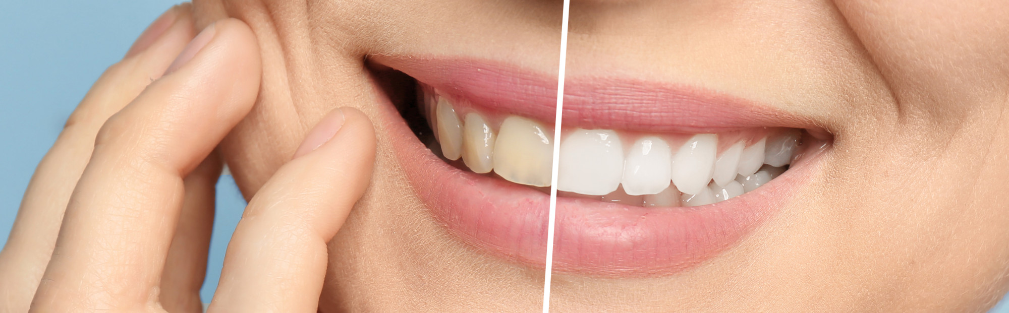 mouth before and after teeth whitening