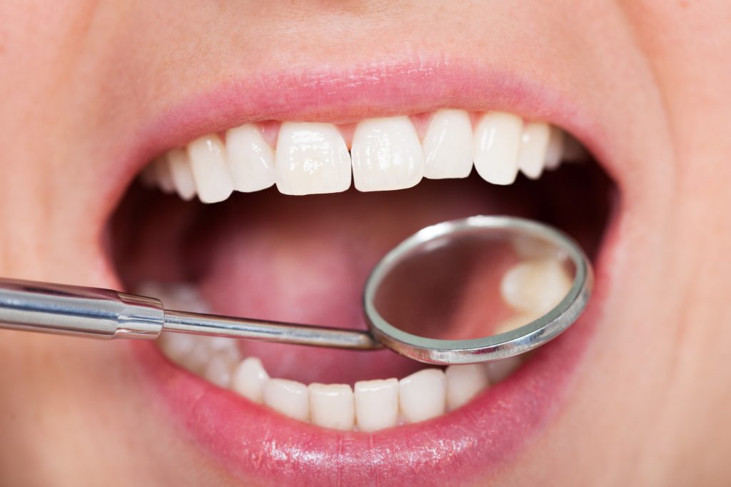 Temporary Tooth Filling