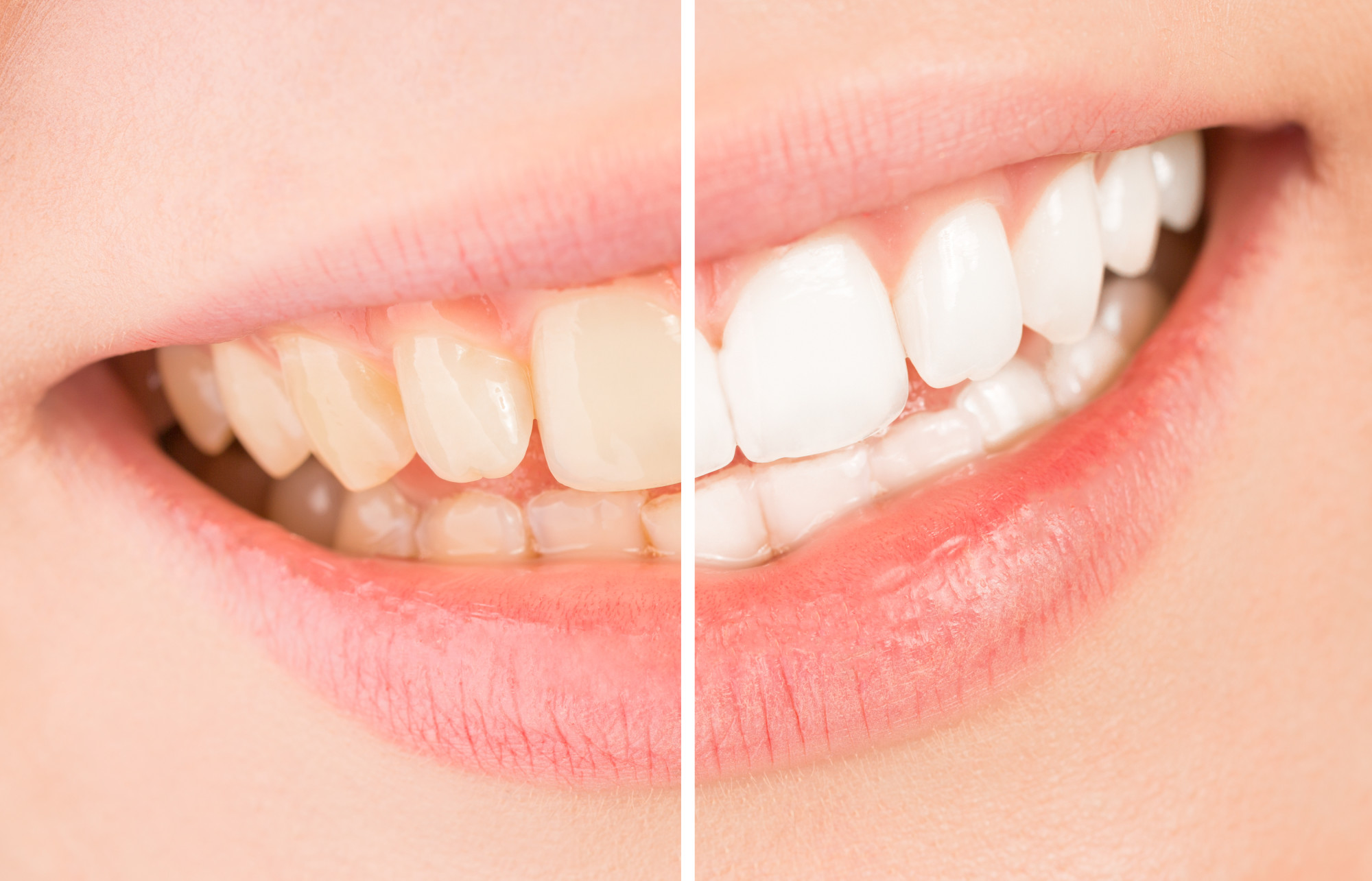 Teeth Whitening Mistakes