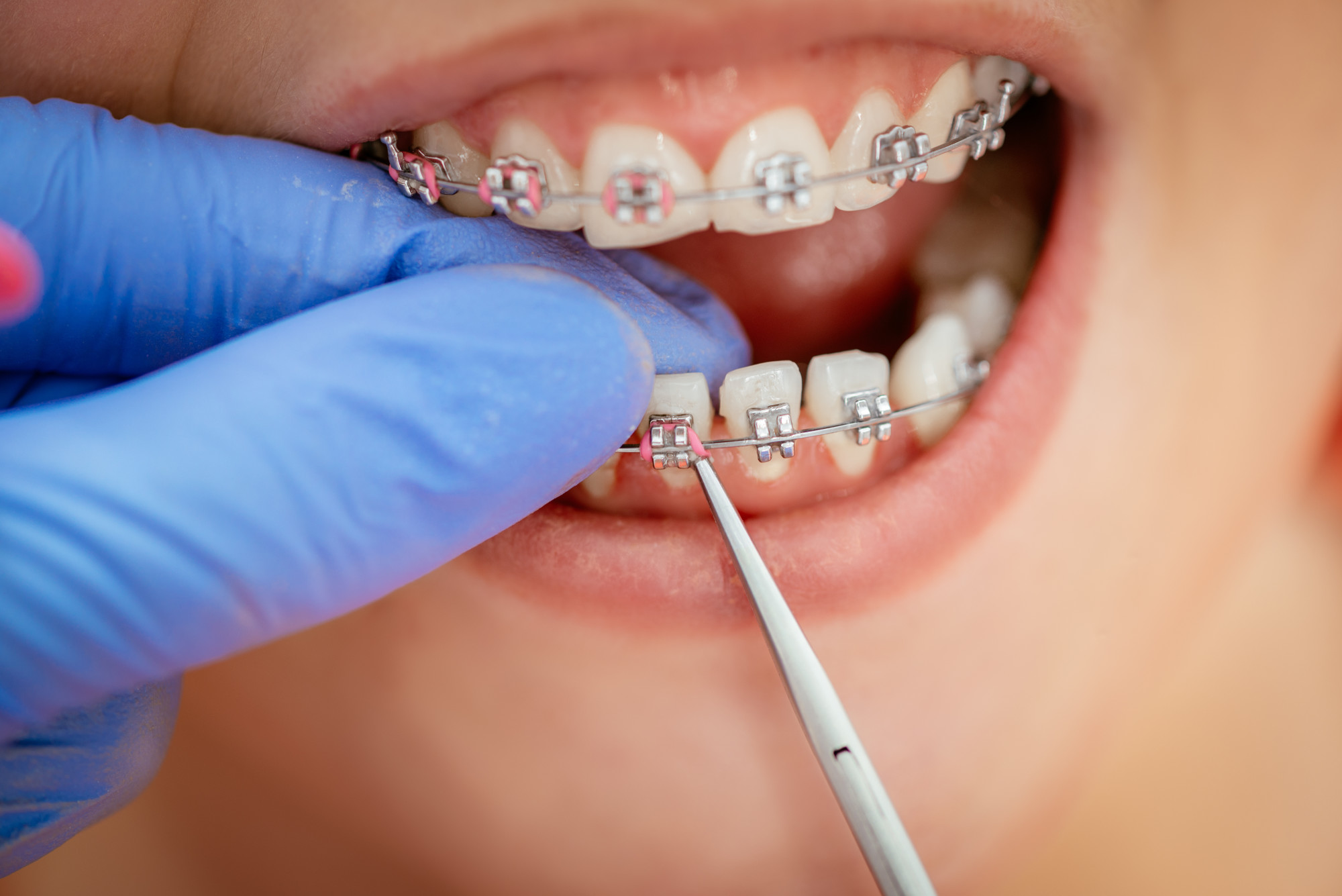 Best Age to Get Braces