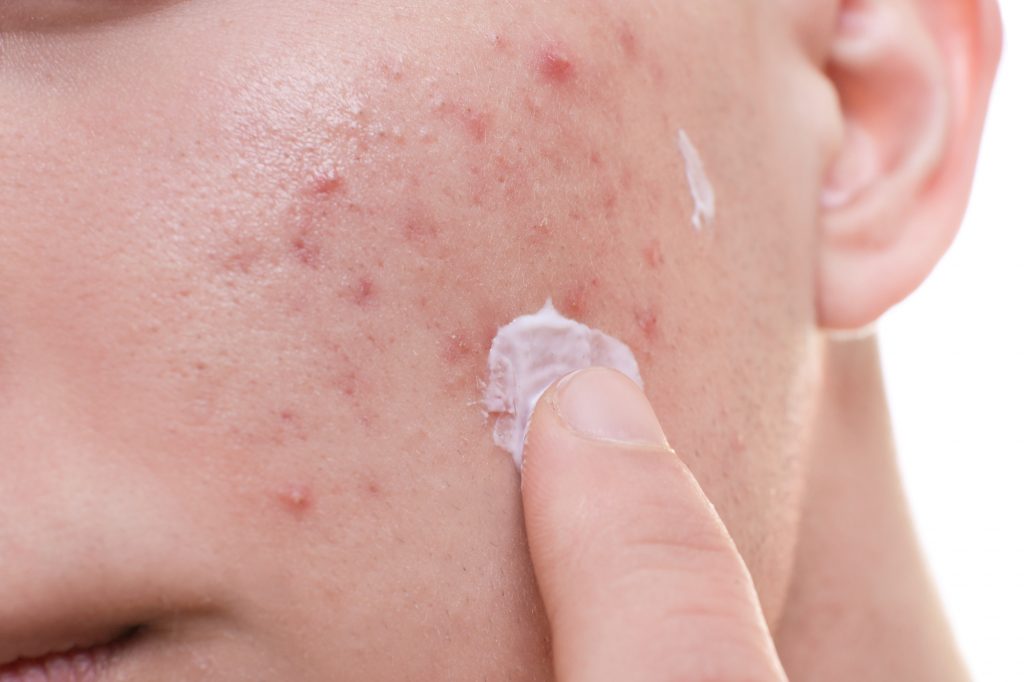 Treat and Prevent Painful Acne