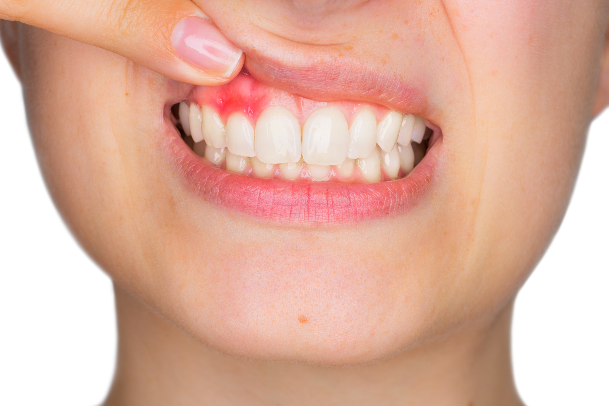 Signs of Gum Disease